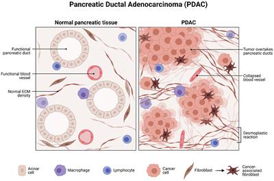 Liquid Biopsy as a Prognostic and Theranostic Tool for the Management of Pancreatic Ductal Adenocarcinoma